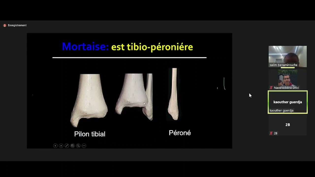 #Ortho | 28.  Fractures bi malléolaires (Dr Benamirouche)