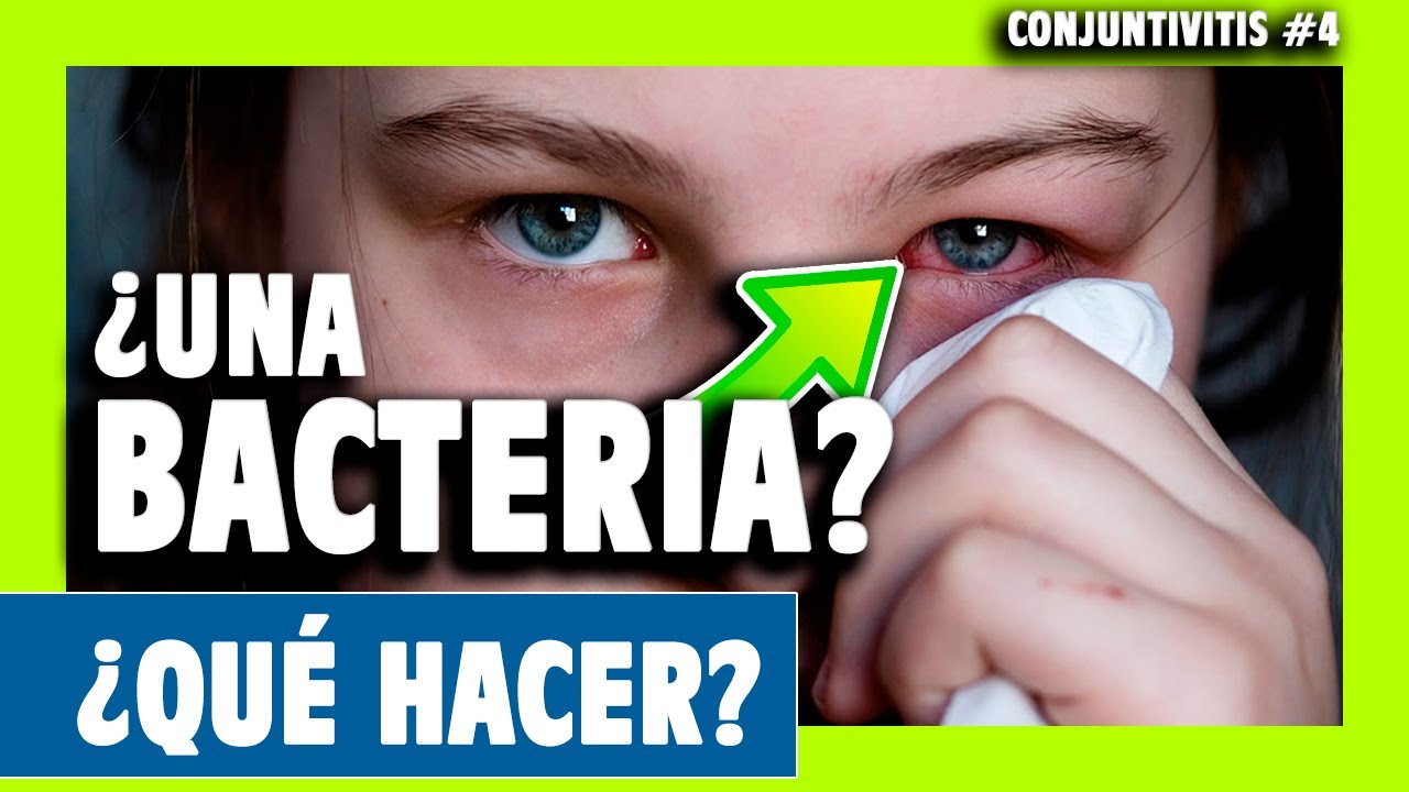 ▶️ CONJUNTIVTIS BACTERIANA: Tratamientos y pasos a seguir... [Cap&iacute;tulo #4]