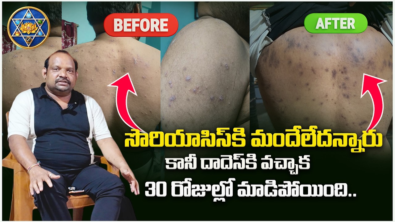 30 రోజుల్లో సొరియాసిస్ మాడిపోయింది..| Amazing Result Of Psoriasis | Drdadhes