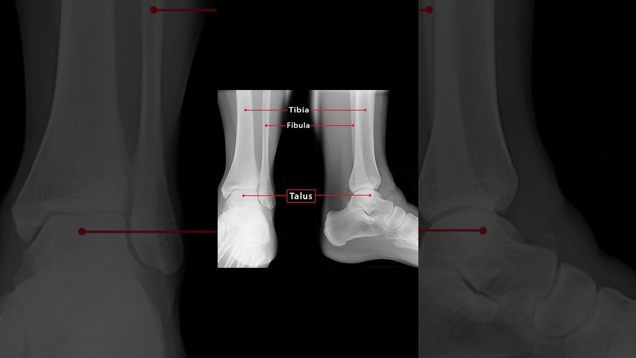 🦴 Zrozumieć kość skokową | Klucz do stabilności stawu skokowego! #anatomia #fizjoterapia #ATC #po...