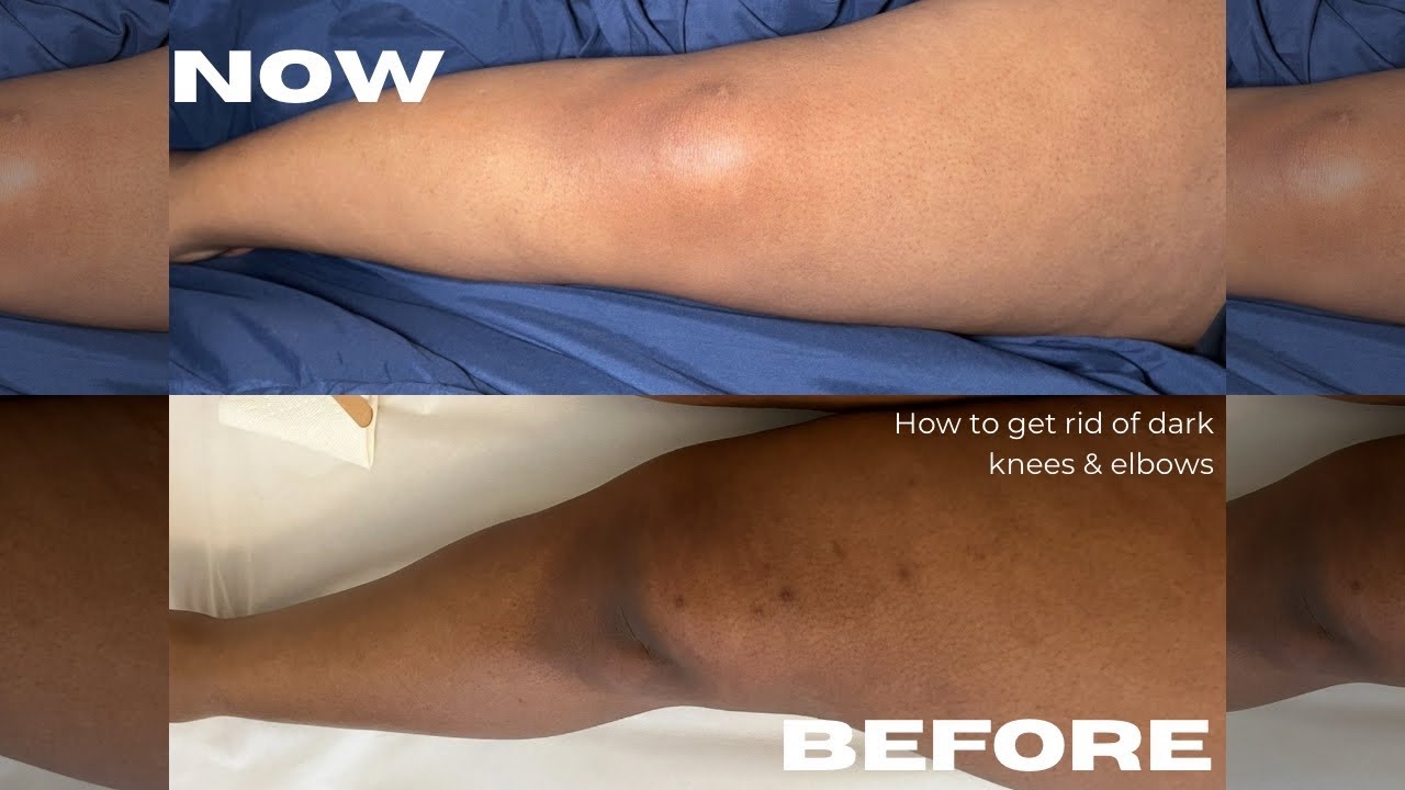 HOW I GOT RID OF HYPERPIGMENTATION ON MY KNEES & ELBOWS