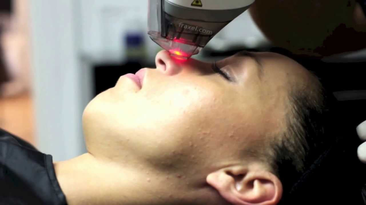 Laser Fraxel DUAL par le docteur thierry lafitte medecin esthetique paris