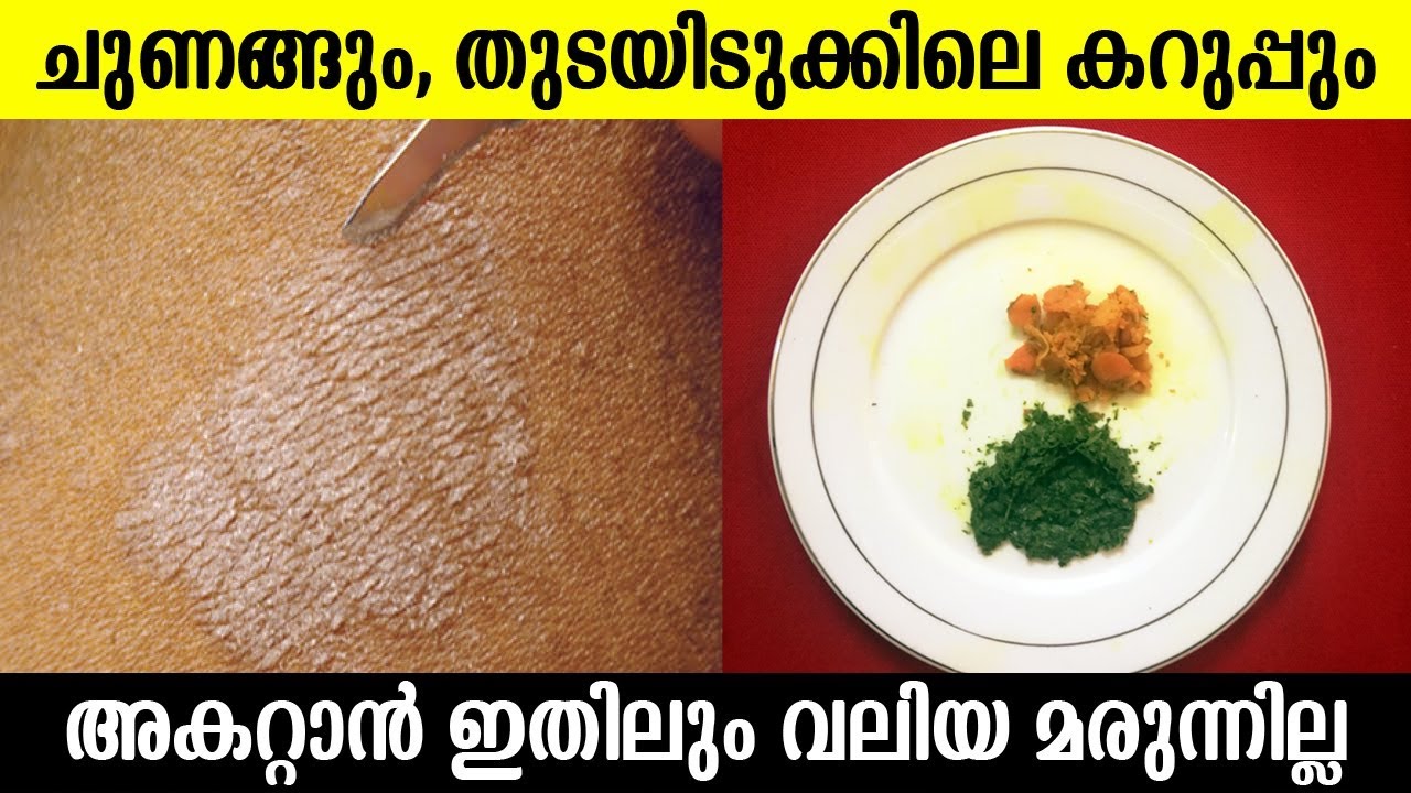 ചുണങ്ങും, തുടയിടുക്കിലെ കറുപ്പും മാറാൻ ഇതിലും വലിയ മരുന്നില്ല |Get Rid of Tinea Versicolor