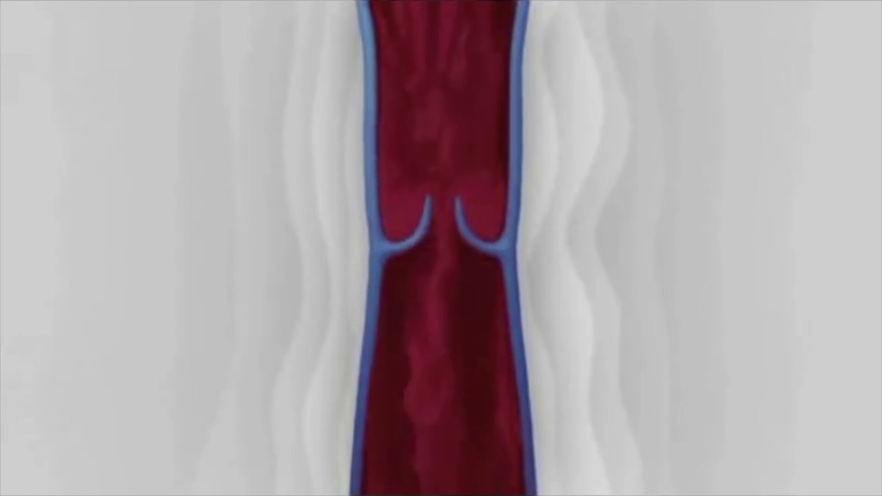 Adieu les varices sous anesthésie générale