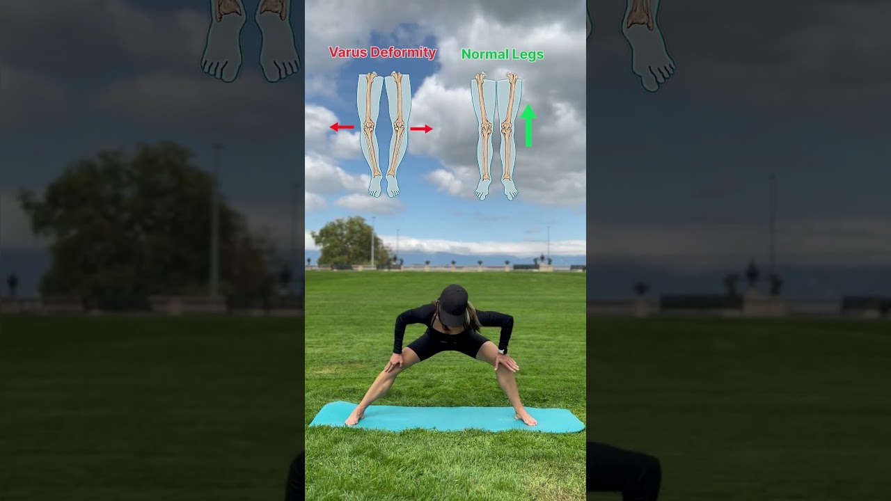 Correct valgus knees with this simple exercise! #valgus #knockknees #legalignment #legexercises