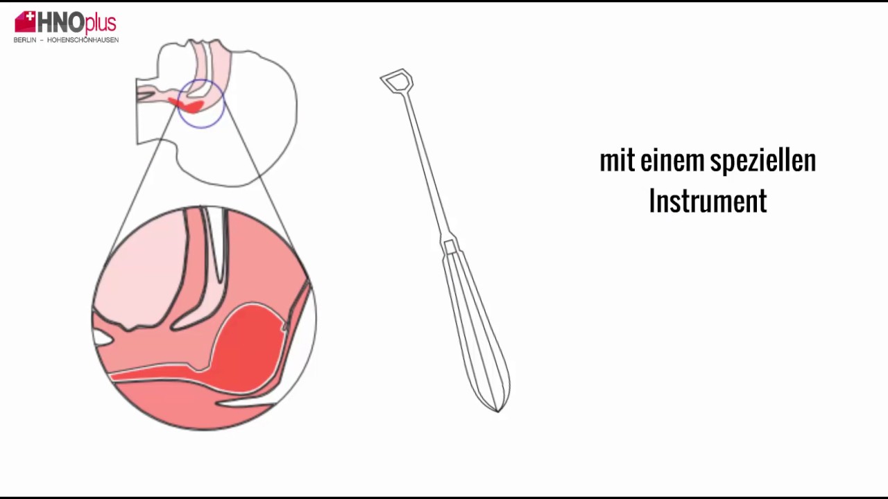 Polypen entfernen OP