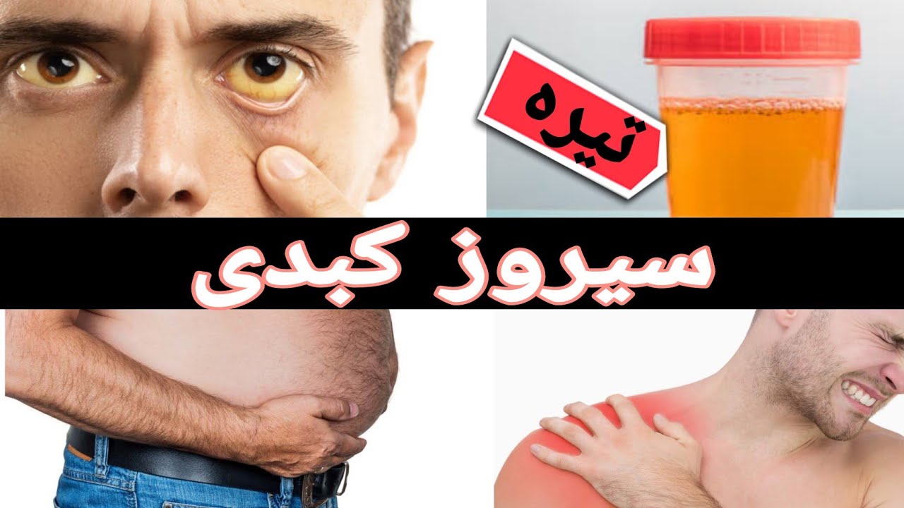 نشانه های مهم سیروز کبدی چیست؟( هفت نشانه مهم)