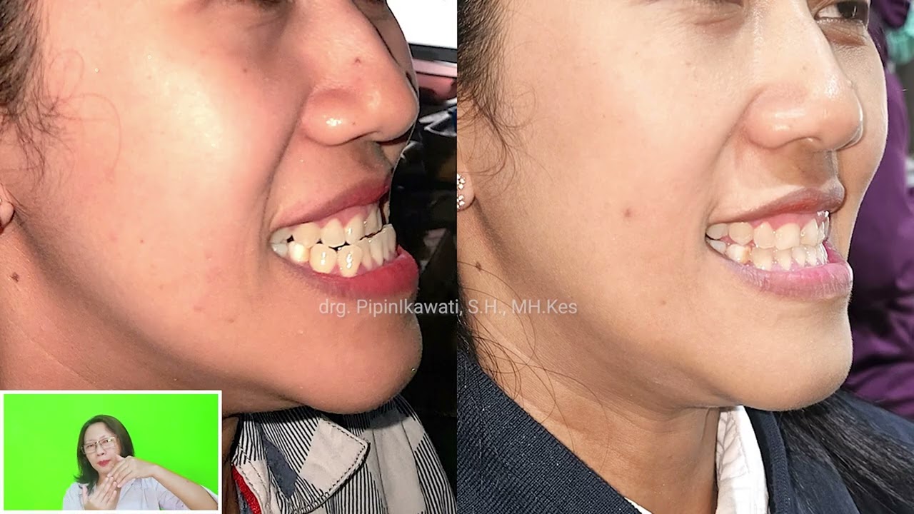 perawatan behel gigi cameh behel gigi cakil behel gigi underbite, rahang bawah majudokter gigi Jogja