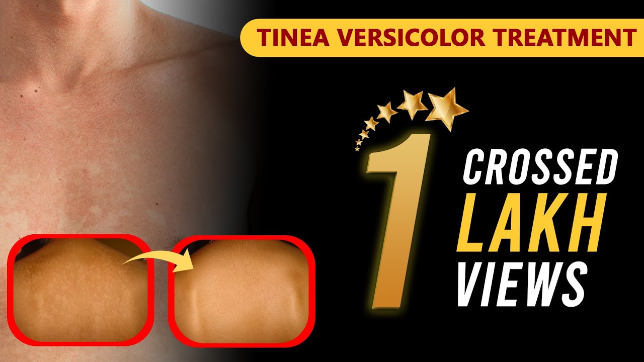 Tinea Versicolor Treatment |  टीनेया वेर्सिकलर  |  કરોળિયા | Dr. Jagdish Sakhiya  | in Hindi