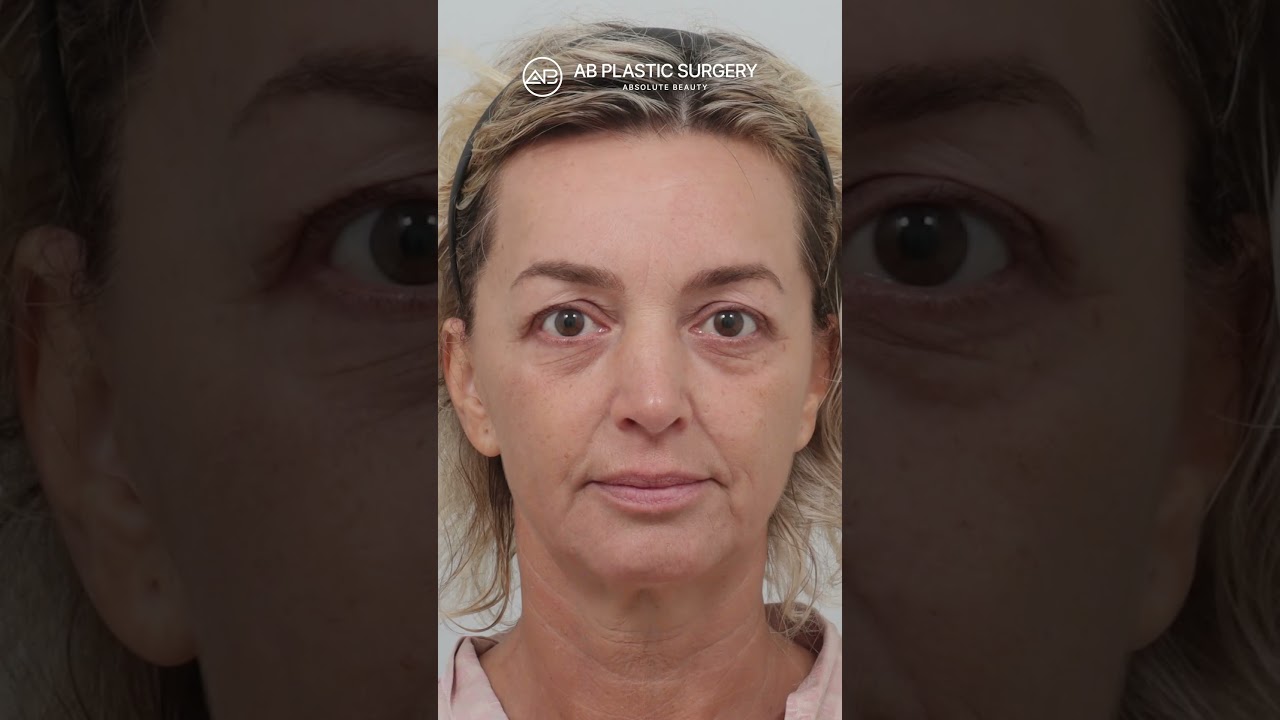 [Plastic Surgery in Korea] My Plastic Surgery Trip to Korea! Facelift & necklift