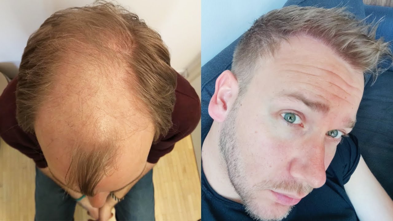 Trapianto di capelli prima e dopo in avanzamento rapido #8