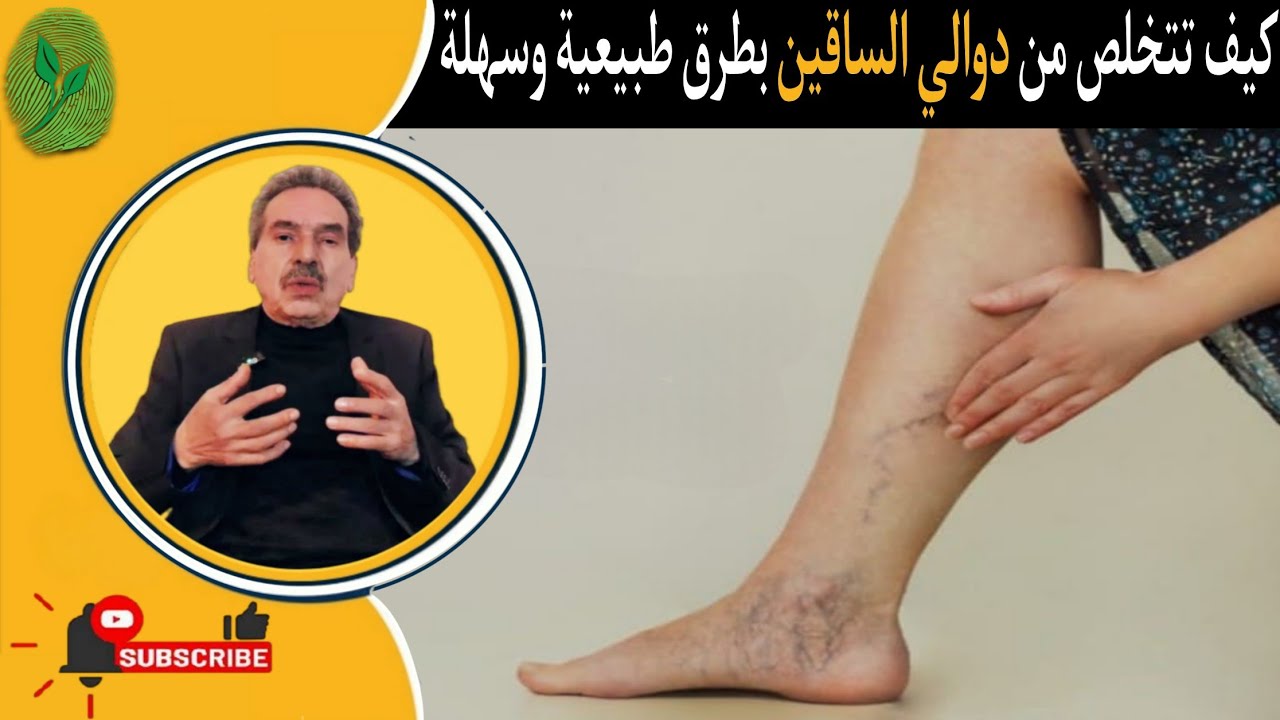 How to get rid of varicose veins naturally and easily with Dr. Jamal Skali