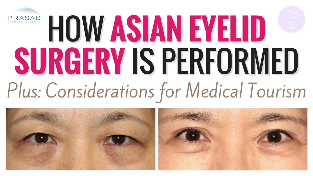 Asian Eyelid Surgery - How Age Often Determines Surgical Technique, and Factors for Medical Travel