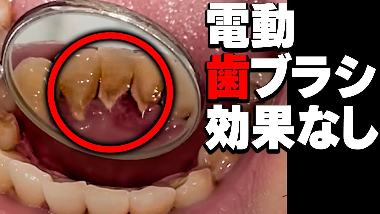【保存版】歯医者が語る、本当に正しい電動歯ブラシの使い方