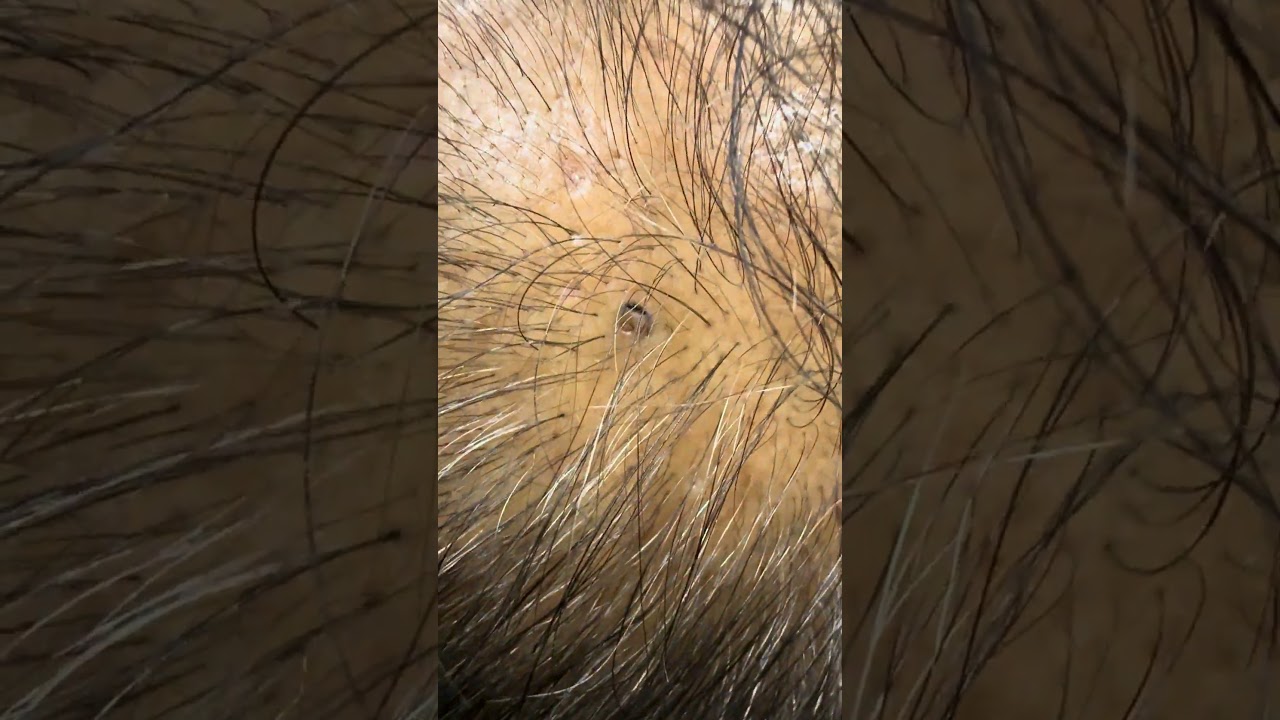 Skincare satisfying videos 😇#hairremoval #remove #pimplepopping #blackheads #acne #asmr #natural
