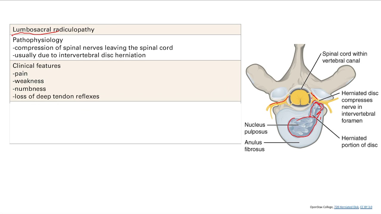 Lumbosacral Radiculopathy | MSK | Step 1 Simplified