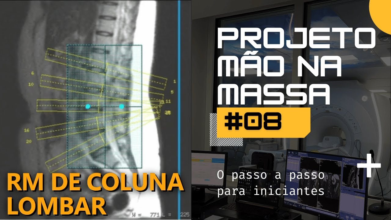 Mão Na Massa 08 | Planejando uma Coluna Lombar