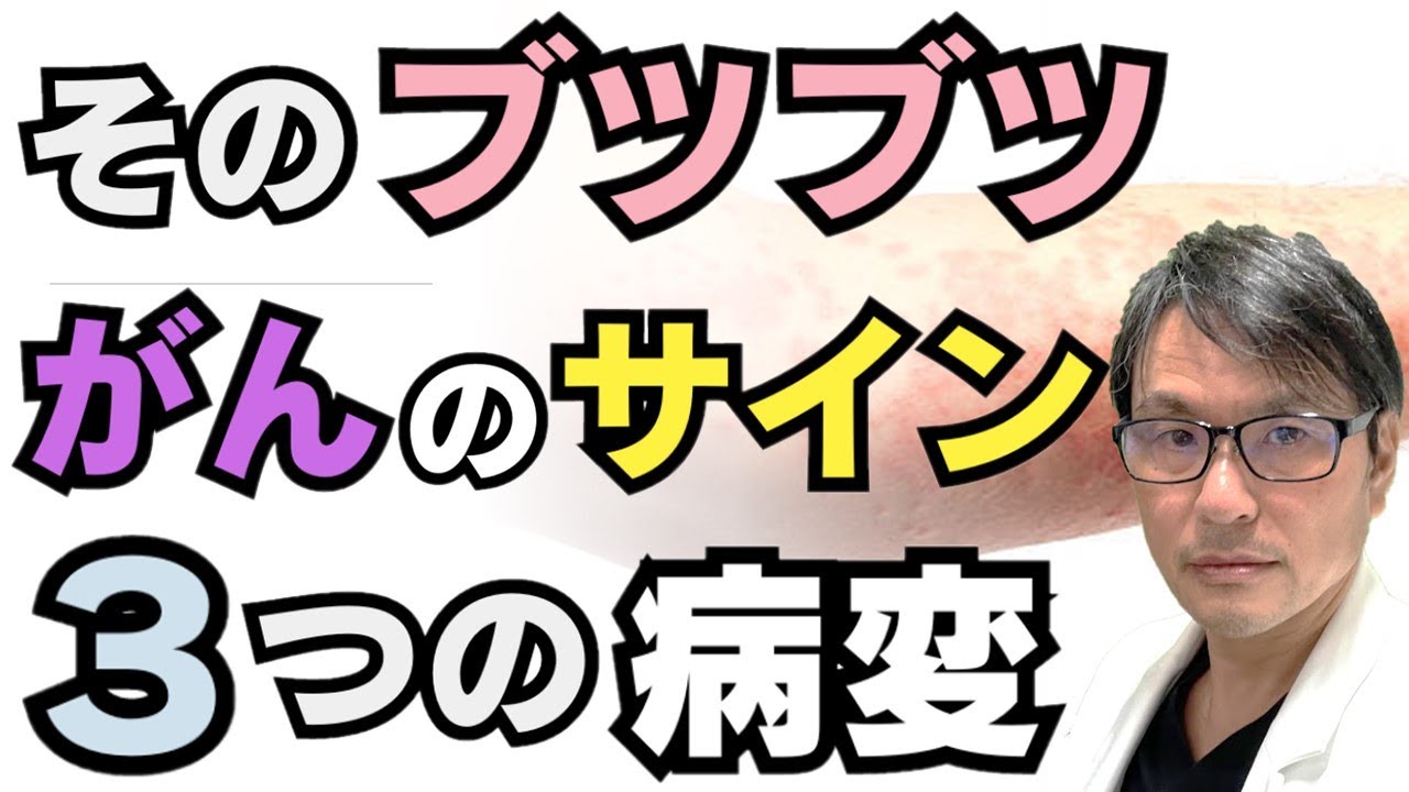 その「ブツブツ」がんのサインかも？注意すべき３つの病変