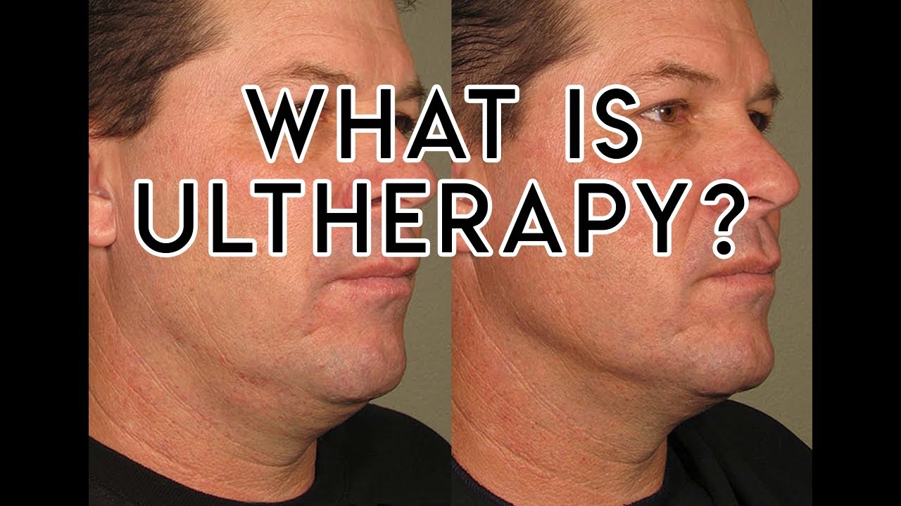 Ultherapy