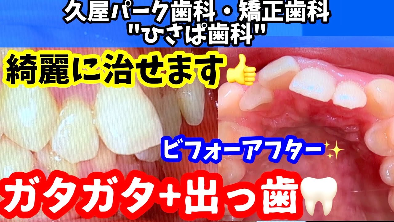 【矯正年間800例】ガタガタ＋出っ歯のビフォーアフター！！歯列矯正で治します！！【出っ歯と言ったらヒサパ！】