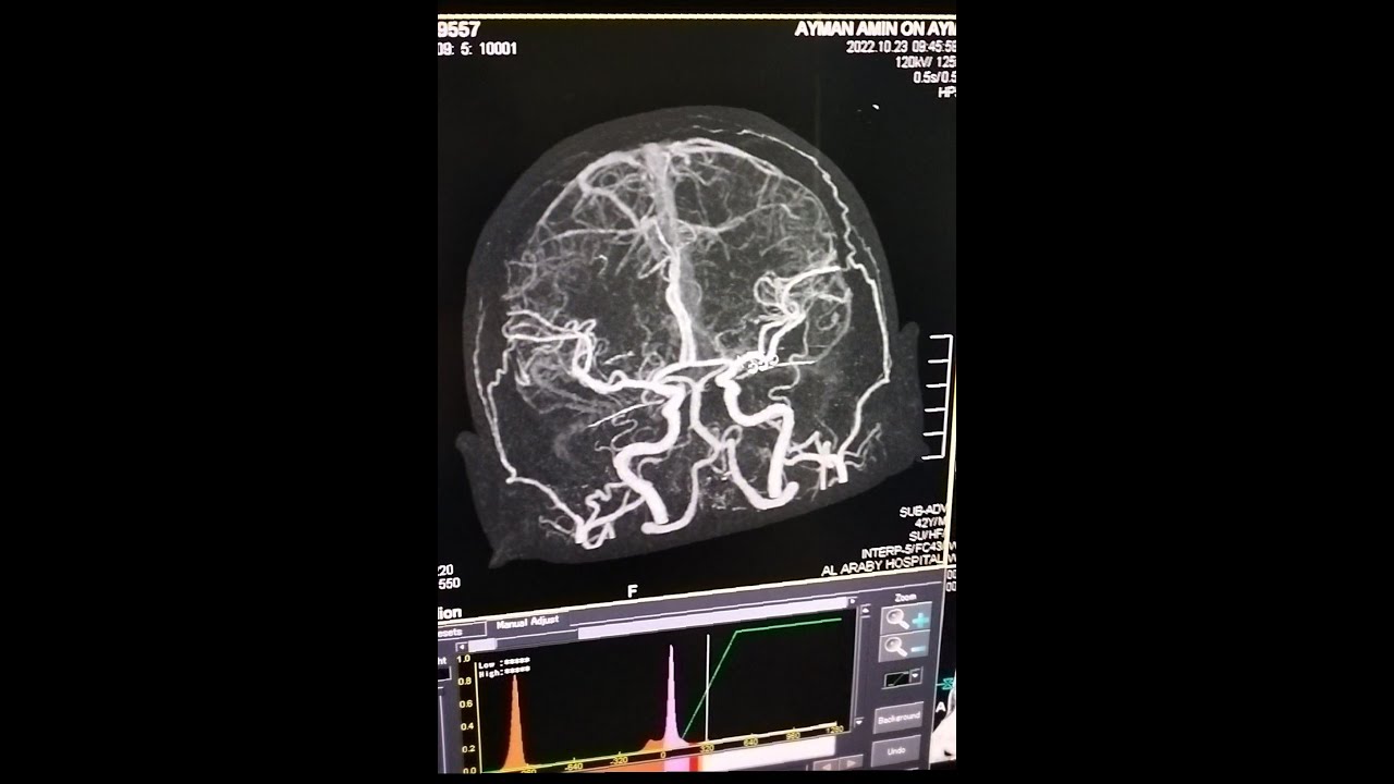 شرح فحص الاشعه المقطعيه علي شرايين المخ بالصبغه علي جهاز توشيبا /CT Cerebral Angiography