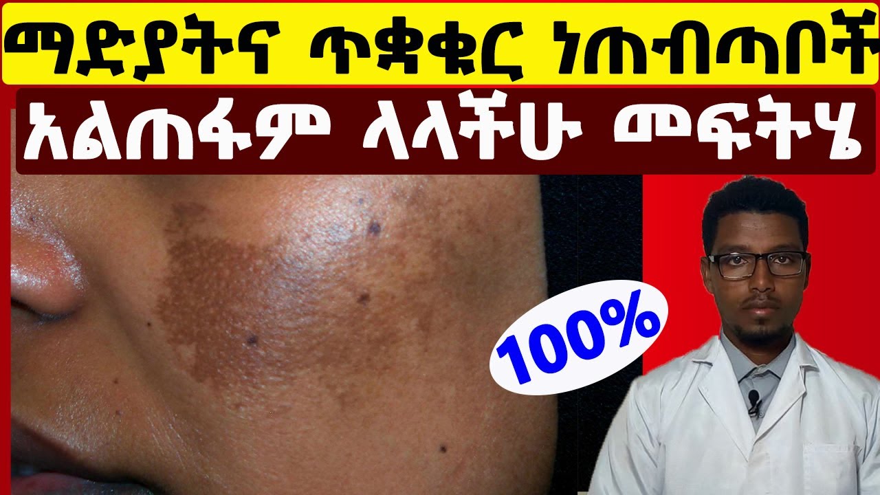 🔴 ማድያት እና ጥቋቁር ነጠብጣቦችን ለማጥፋት ቀላል መፍትሄዎች / How to treat MELASMA at Home.