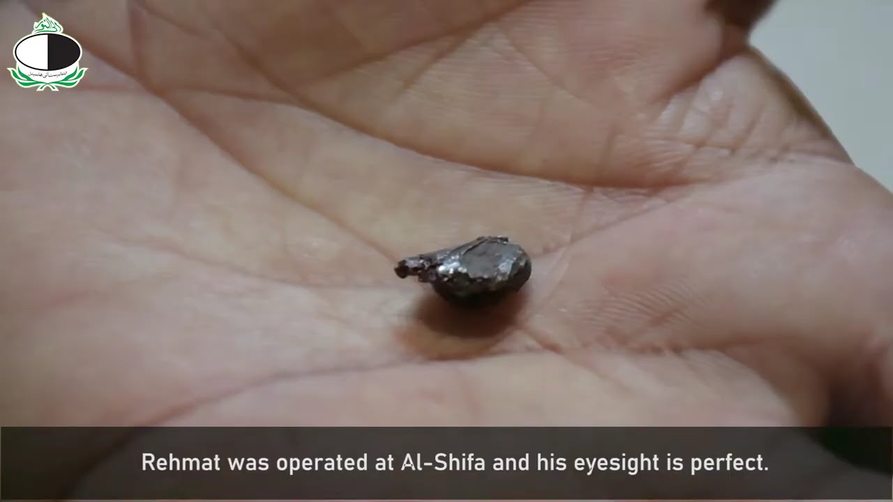Bullet in eye I Al-Shifa Trust Eye Hospital