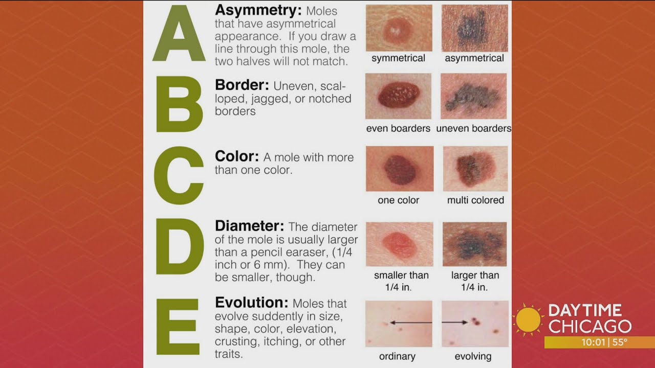 Skin Cancer Awareness Month: Prevention Tips