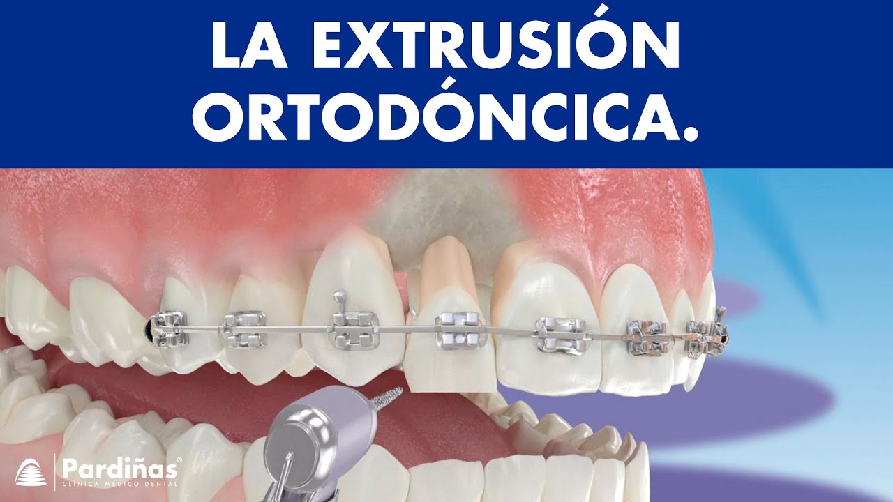 Extrusión ortodóncica ©