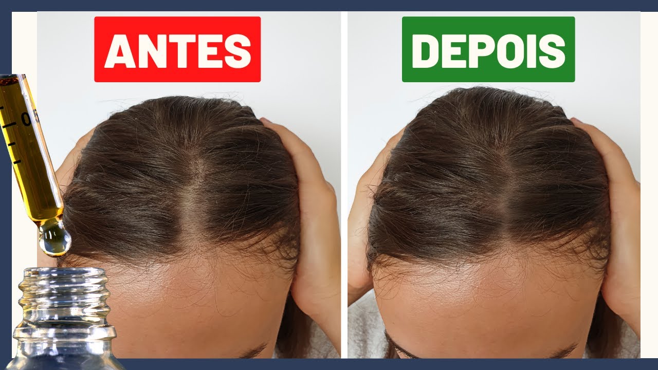 USE este ÓLEO para DIMINUIR a QUEDA de CABELO em 2 SEMANAS! | Dra. Greice Moraes