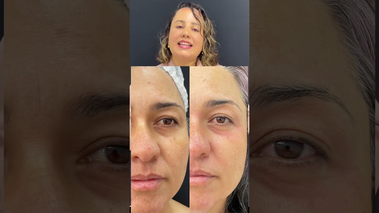 Dicas de cuidados p&oacute;s jato de plasma!! #jatodeplasma #eletrocauterio #estetica