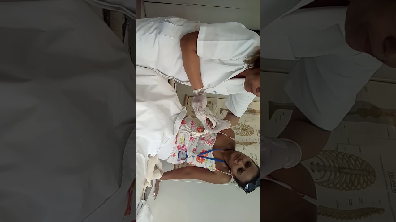 Gesso  axilo palmar em garrafa para escafoide
