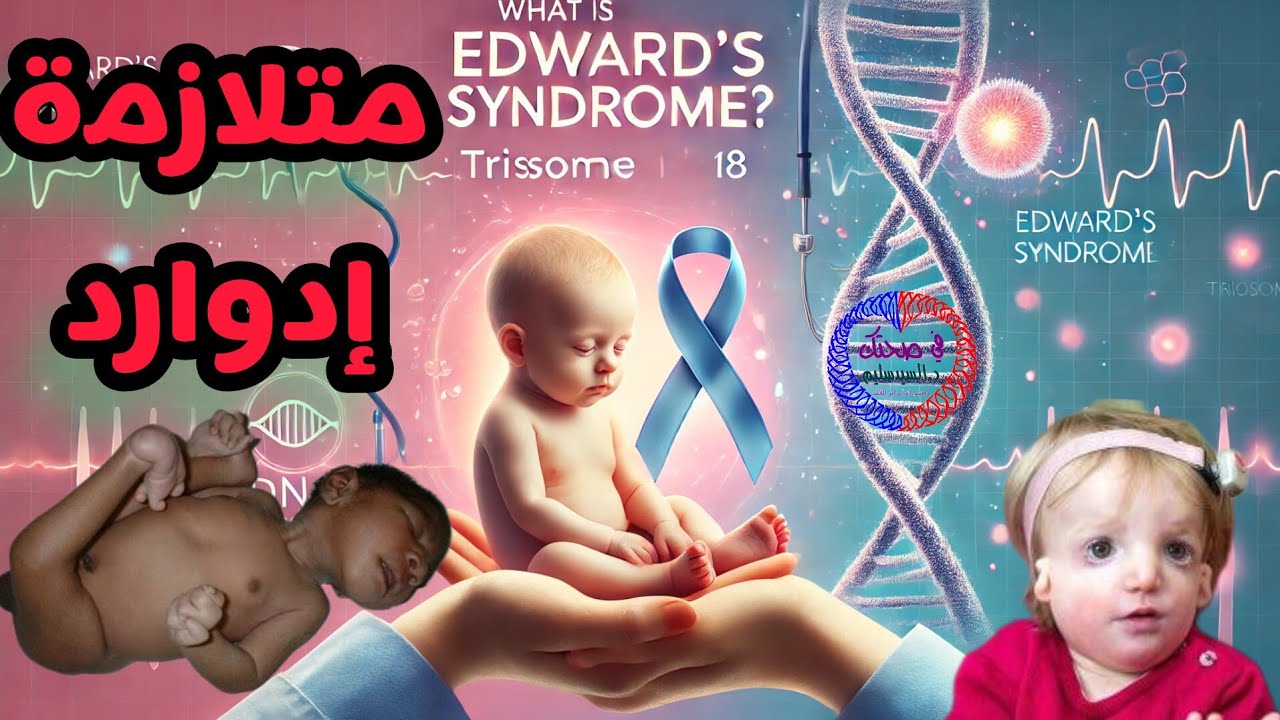 تعرف متلازمة إدوارد ؟