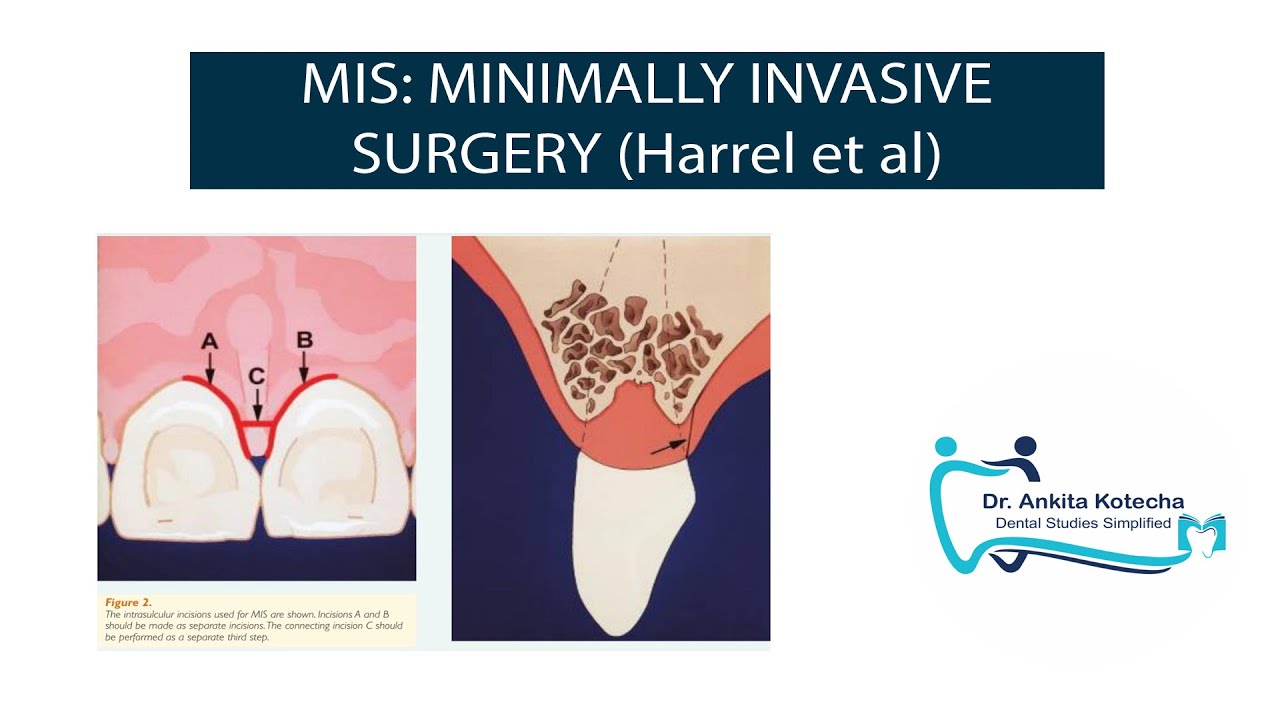 MIS: MINIMALLY INVASIVE SURGERY| Harrel et al| minimally invasive periodontal surgery techniques