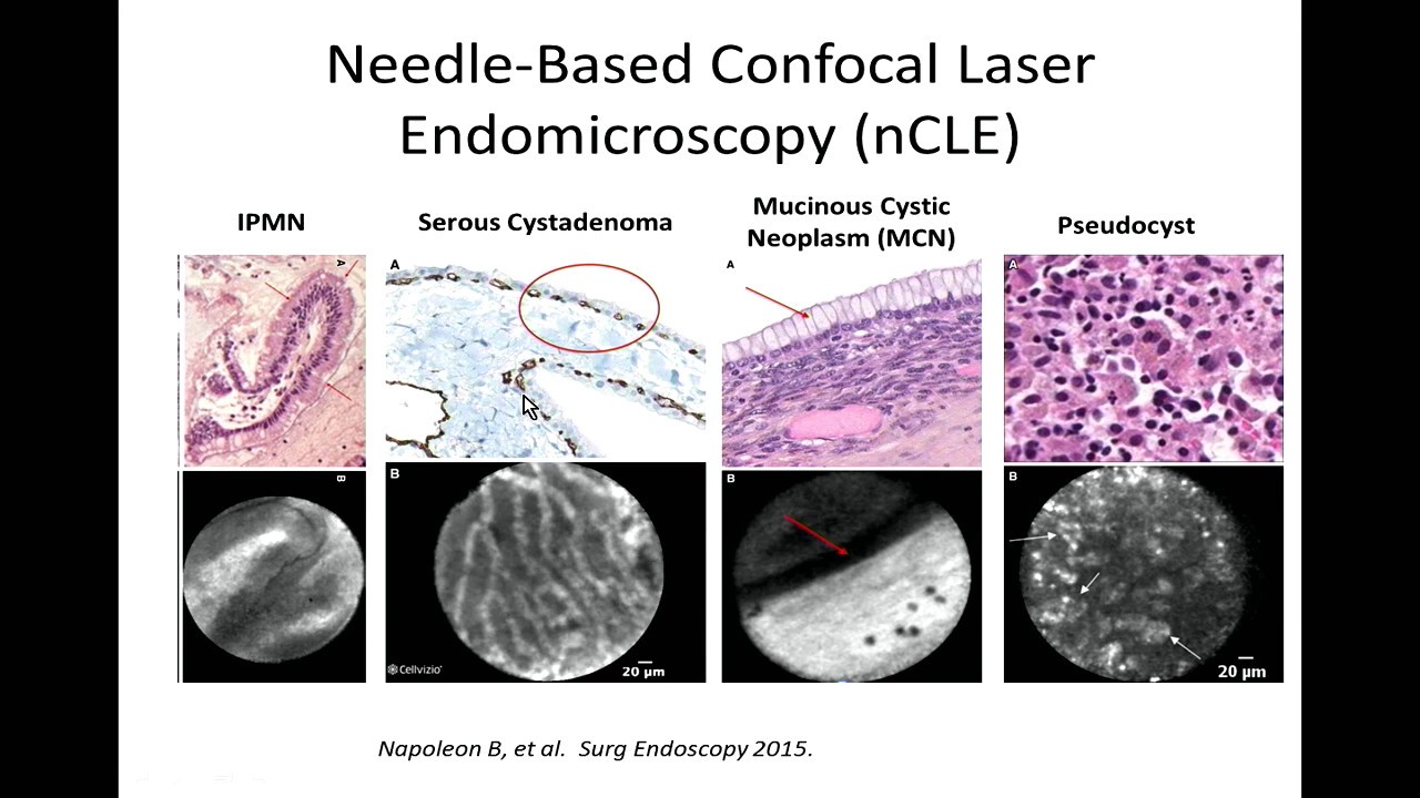 Moving the Needle: Advances in the Management of Pancreatic Cystic Neoplasms
