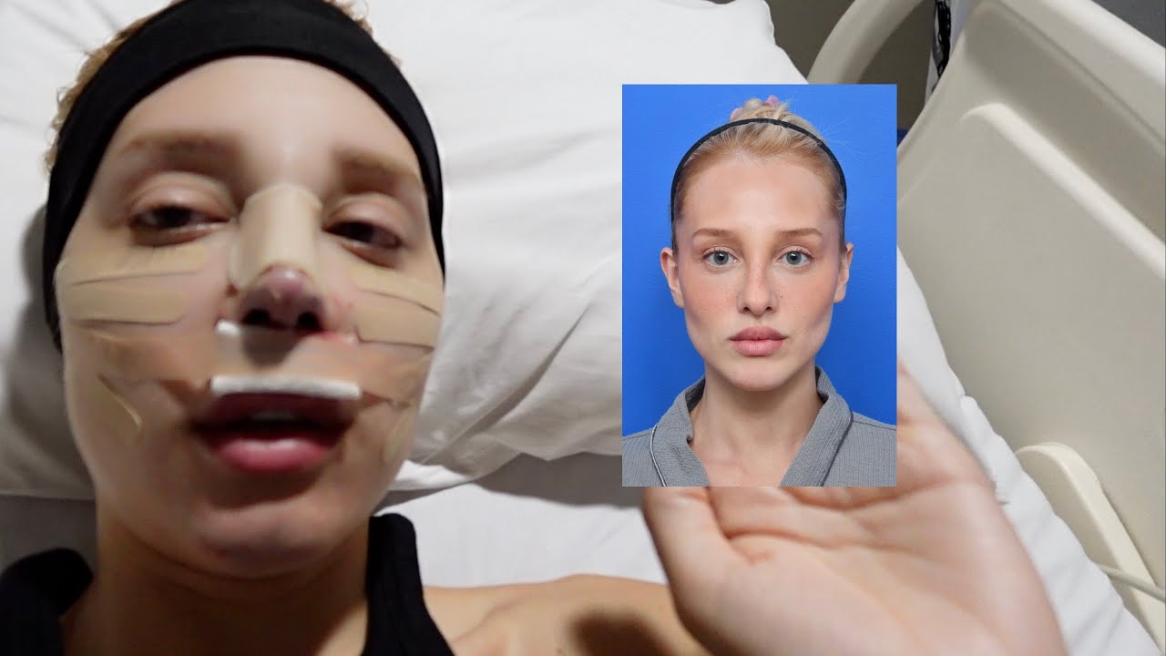 FIZ RINOPLASTIA - malu borges