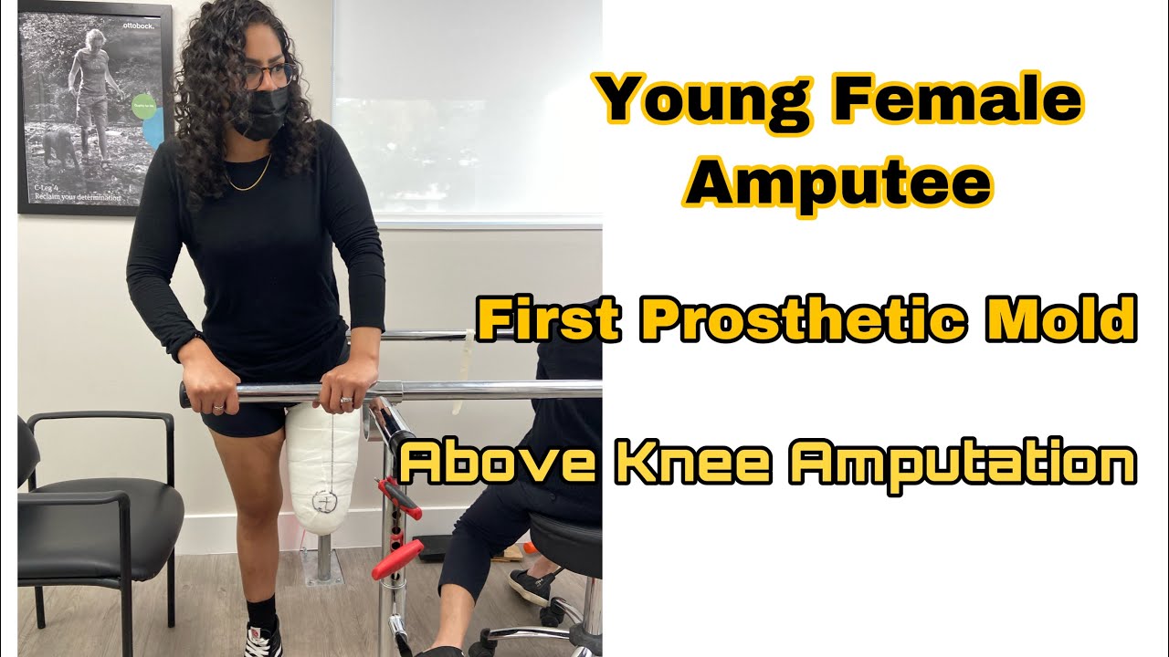 Young Female Amputee First Prosthetic Leg Molding | Above Knee Amputation | AKA