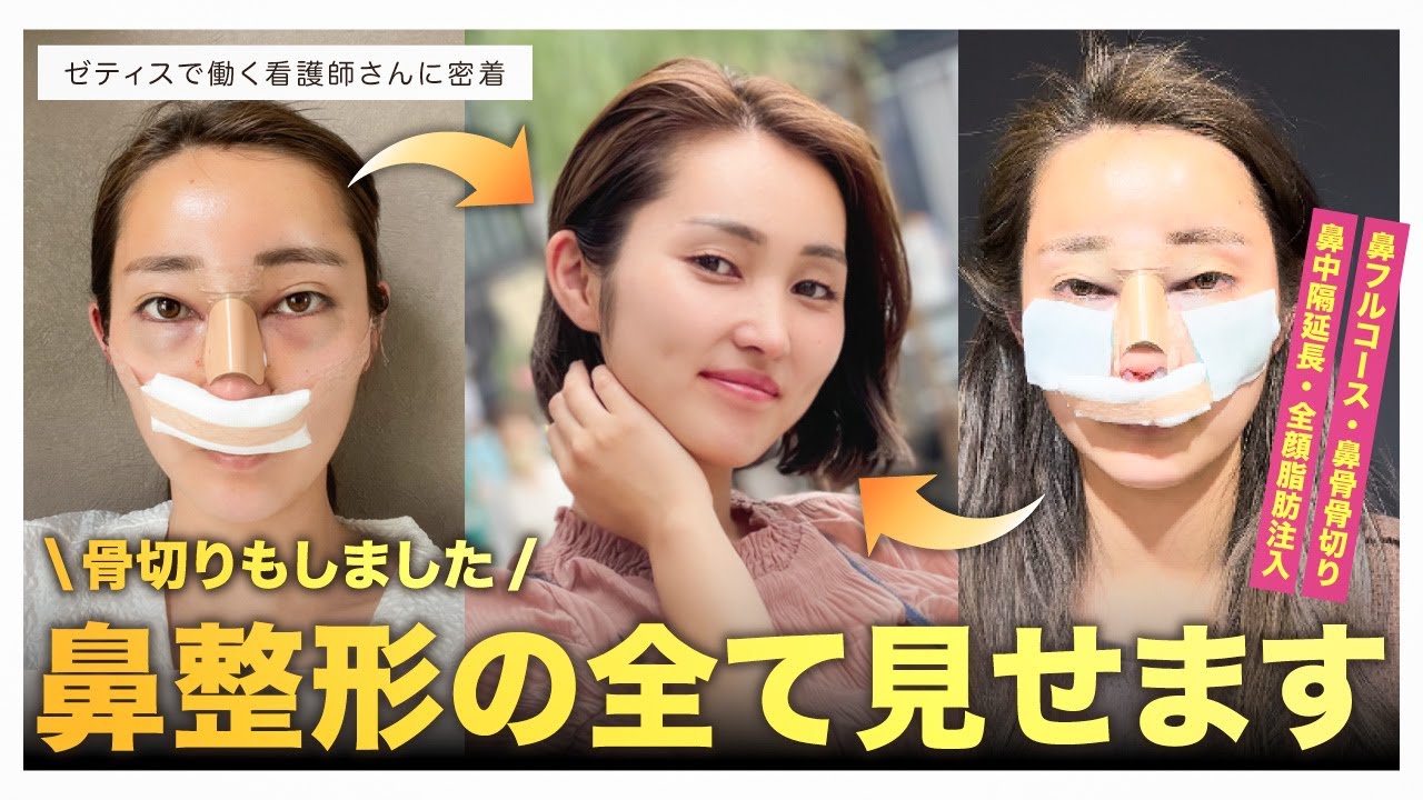 【ゼティス鼻】鼻整形（鼻骨骨切り含む）の経過を紹介 / 術後の腫れ・浮腫み・経験談も全てお見せします【鼻整形/鉄医師】#ゼティス鼻 #美容整形 #zetithbeautyclinic