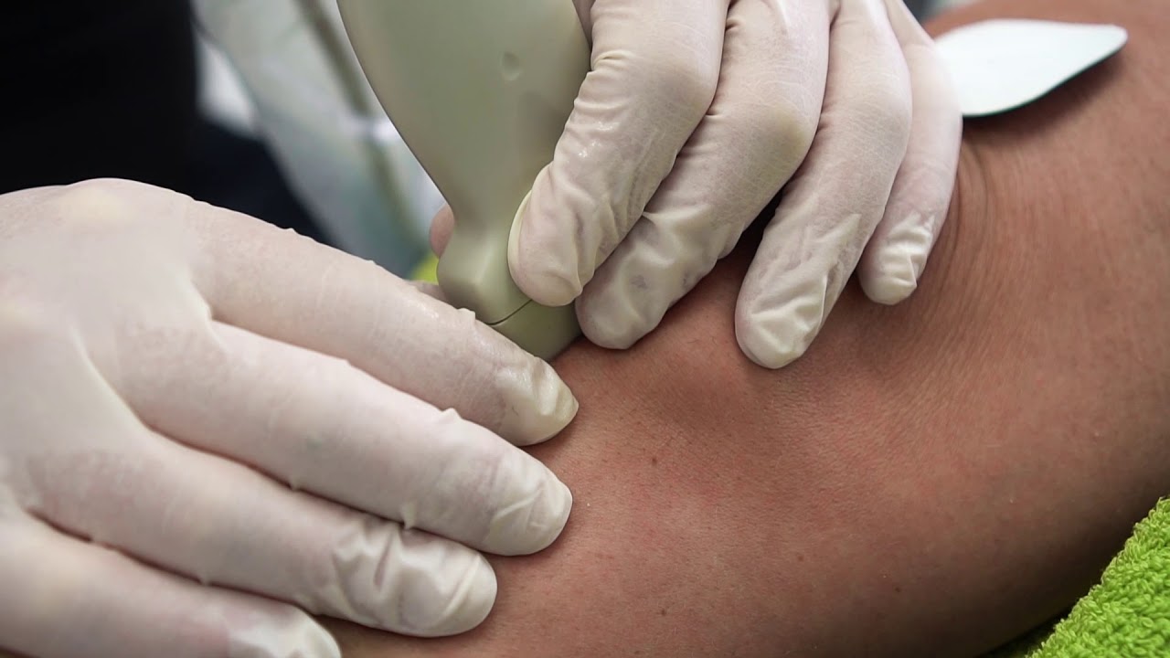 Kolano skoczka - leczenie zmian zwyrodnieniowych przy użyciu Elektrolizy EPTE