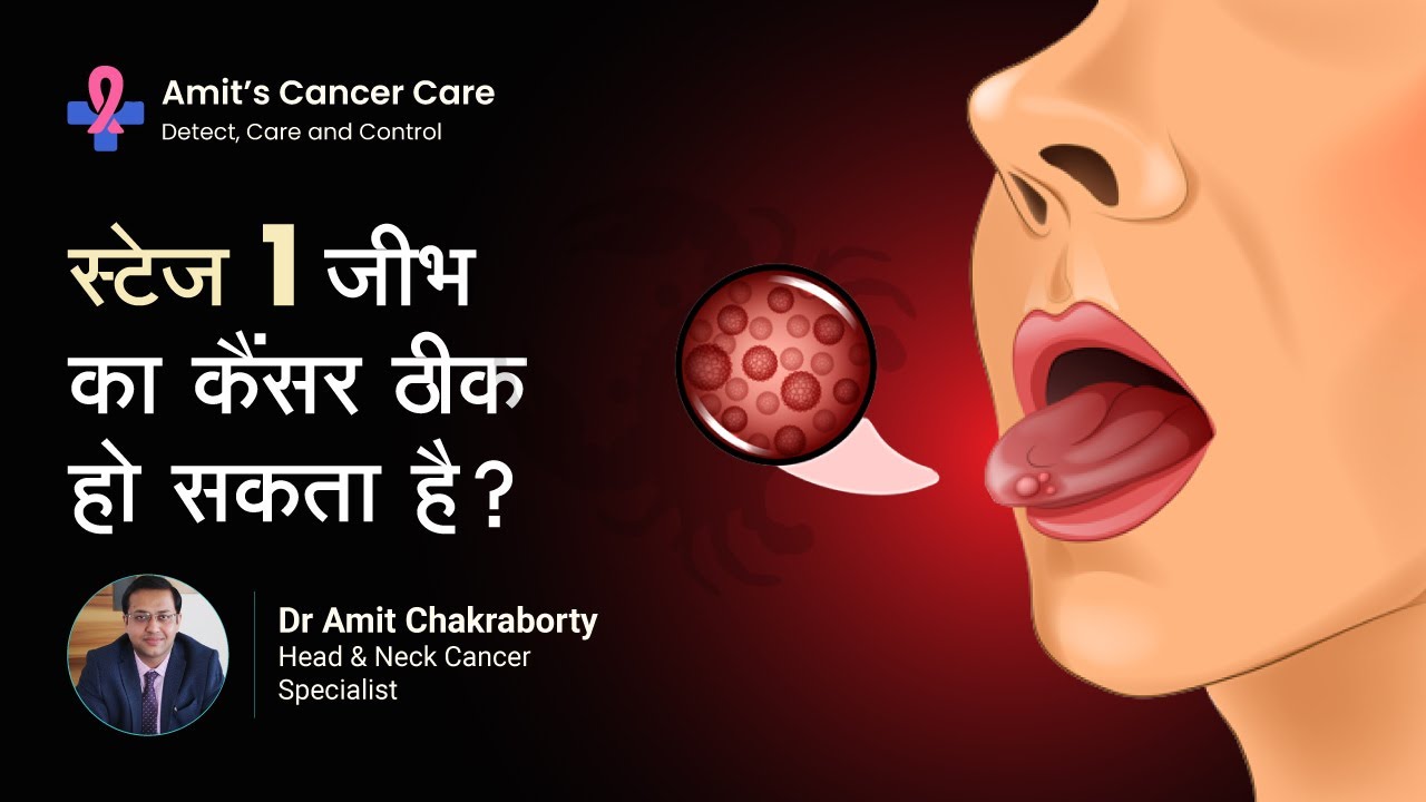 स्टेज I जीभ का कैंसर ठीक हो सकता है या नहीं? | Is Stage I Tongue Cancer curable or not | Dr  Amit C