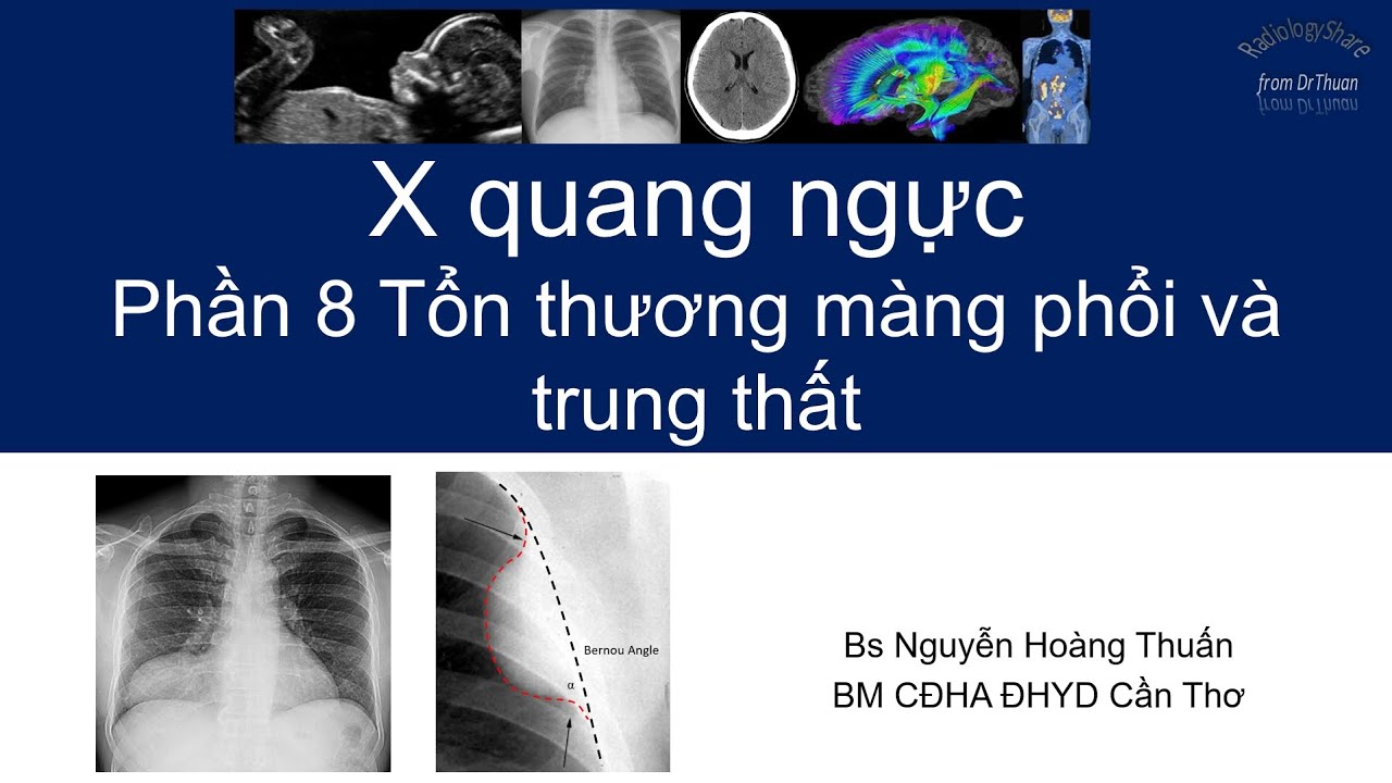X quang ngực 2021- Phần 8 - TT màng phổi và trung thất