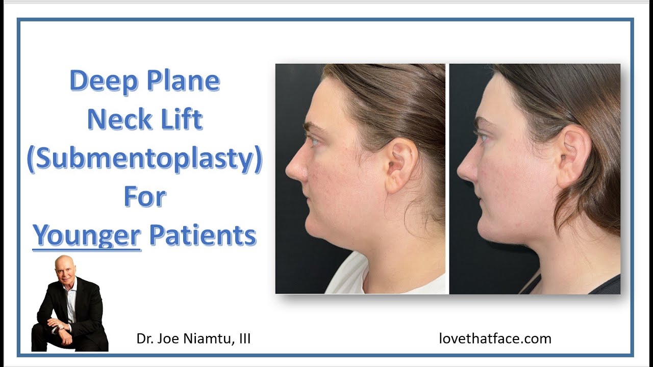 Deep Plane Neck Lift (Submentoplasty) for Younger Patients