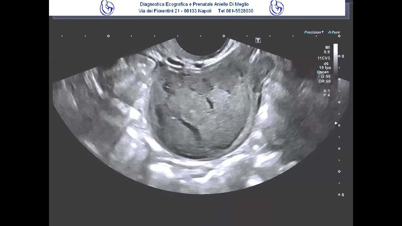 Fibrome ovarien