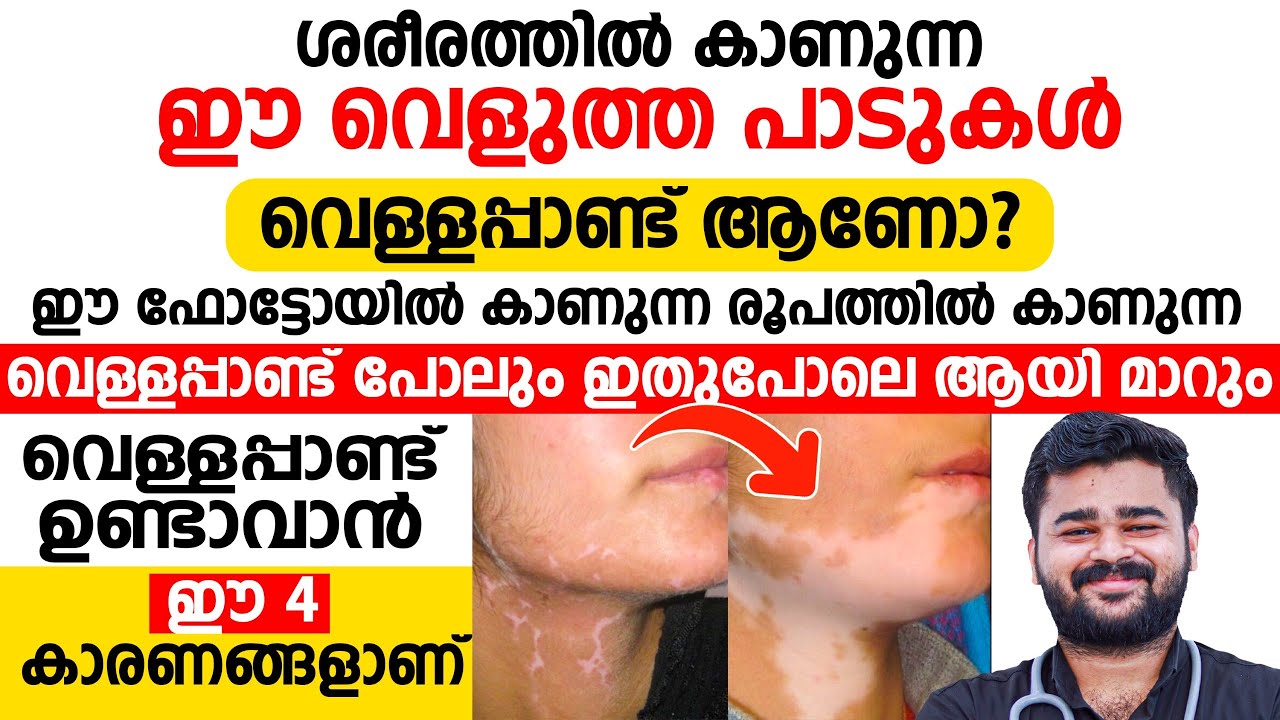 ശരീരത്തിൽ കാണുന്ന ഈ വെളുത്ത പാടുകൾ വെള്ളപ്പണ്ട് ആണോ | vella pandu malayalam | Dr Siraj