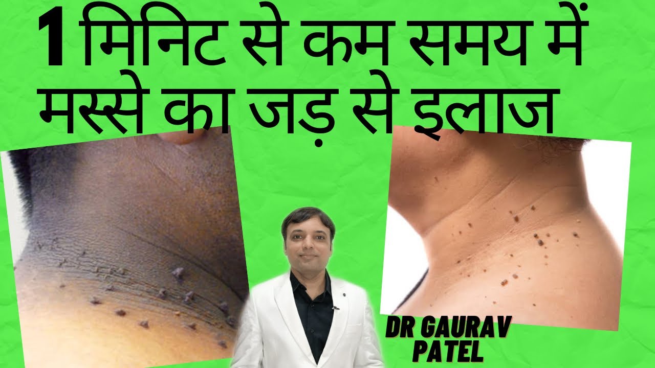 मस्से को जड़ से हटाने के उपाय | मस्से का जड़ से इलाज ।Treatment for skin tag removal |masse ka ilaj