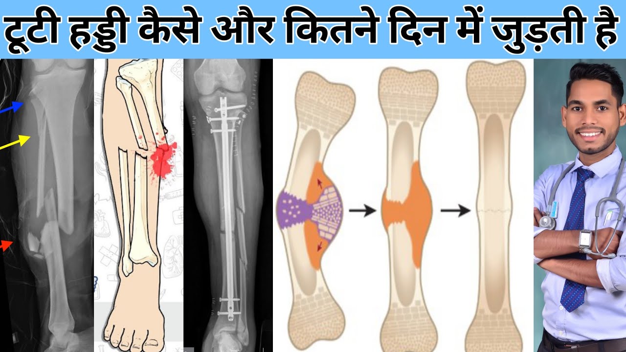 haddi kitne din mein jud jati hai, हड्डी कैसे जुड़ती है, pair ka fracture kitne din me thik hota hai