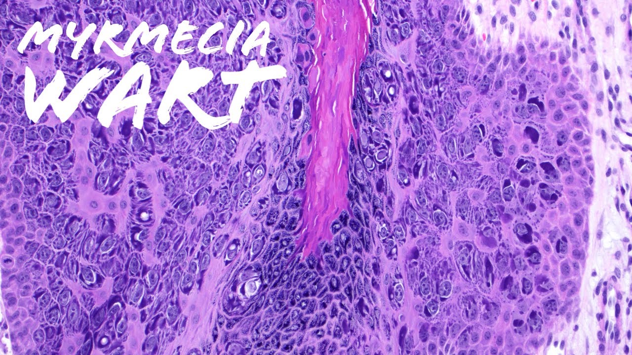 Myrmecia Wart (plantar wart under the microscope, verruca, palmar wart) pathology dermpath