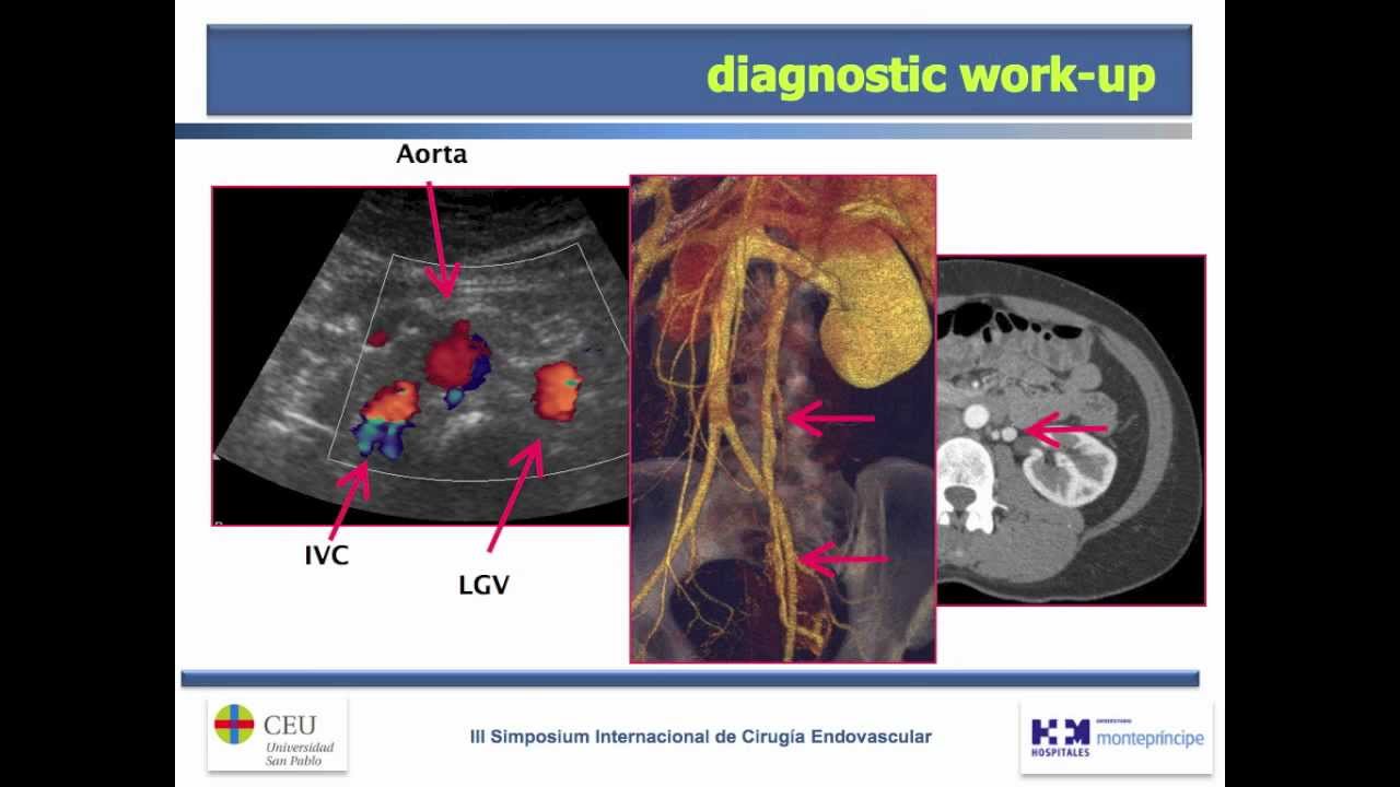 Embolization in pelvic venous disease