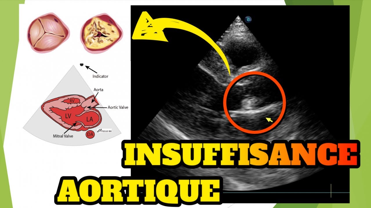 L'échographie cardiaque: valve aortique défaillante