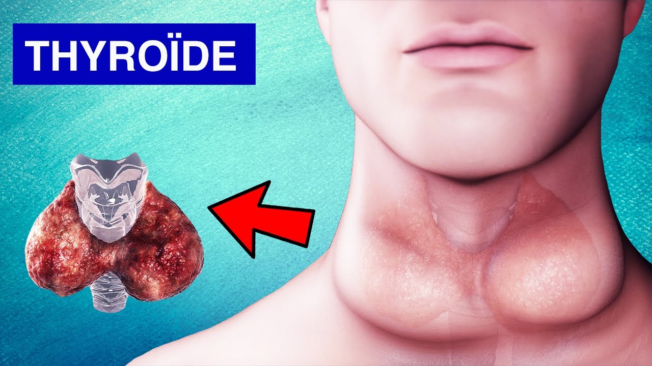 Glande Thyroïde : Pathologies, Symptômes et Traitements